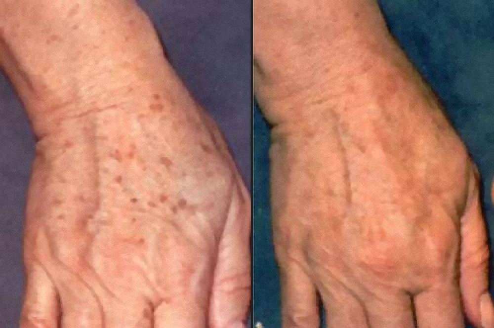 Dermaroller pigmentation picture before and after