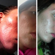 dermaroller before and after photo