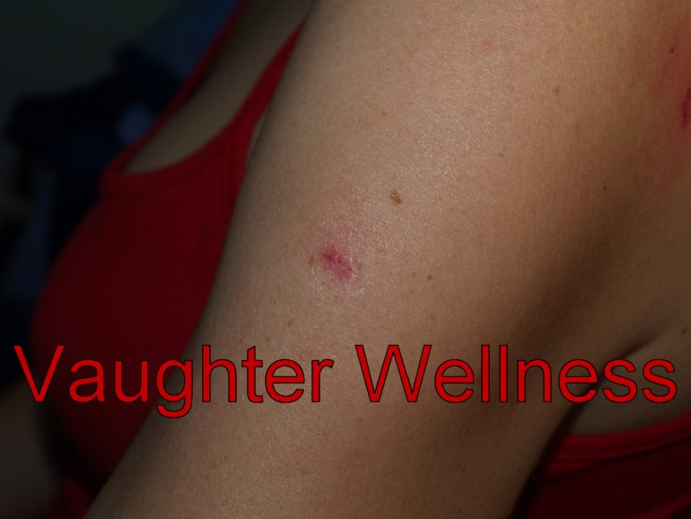 scar-after-needling