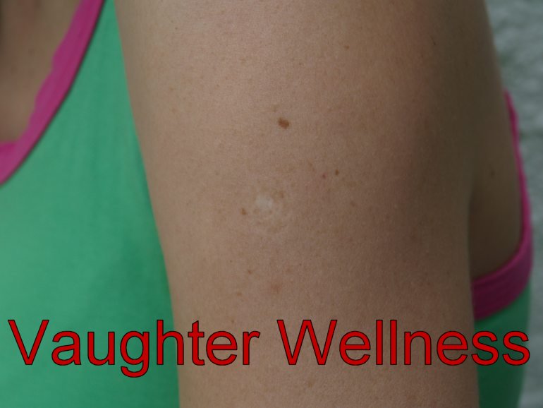 scar-before-needling