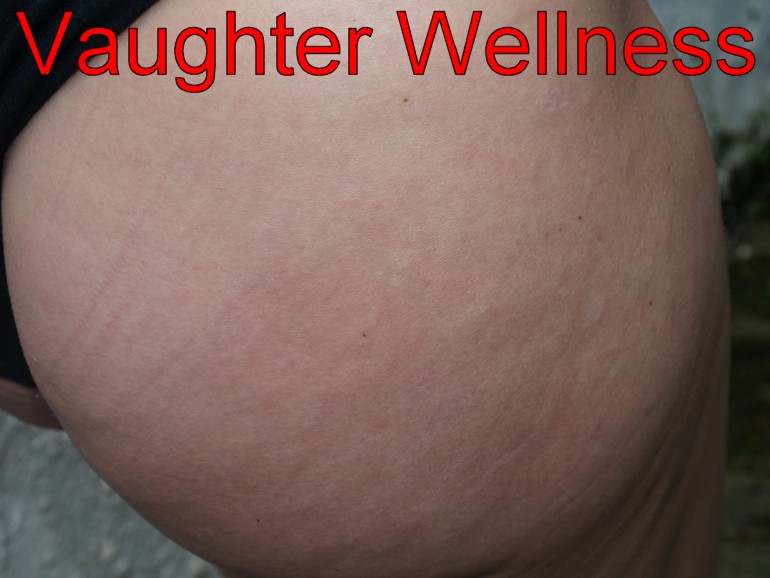 tanned-treated-stretchmarks-bottom Stretchmarks after single needle