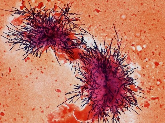 Candida albicans in direct smear of Positive Blood Culture.
